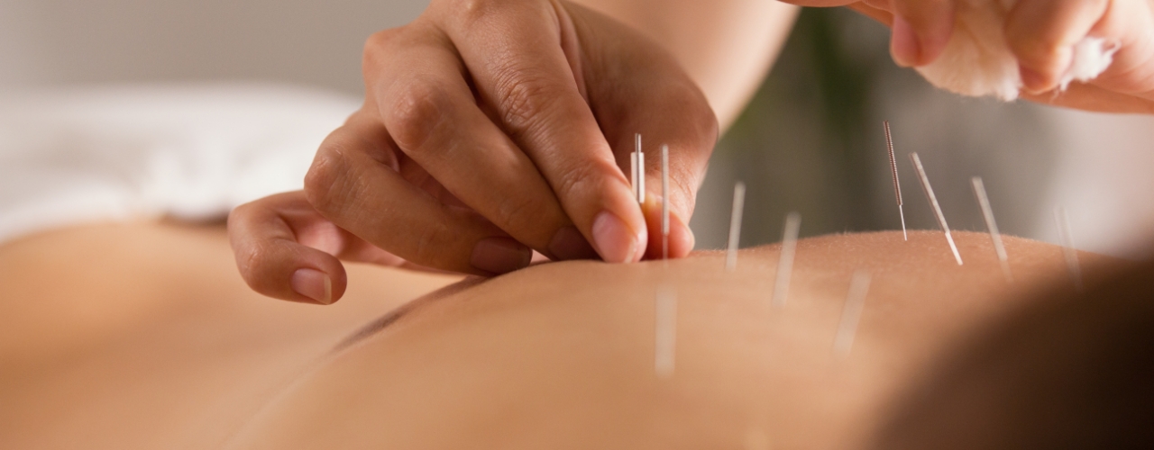 dry-needling-physioworks-physical-therapy-silverdale-kent-WA-1280x500