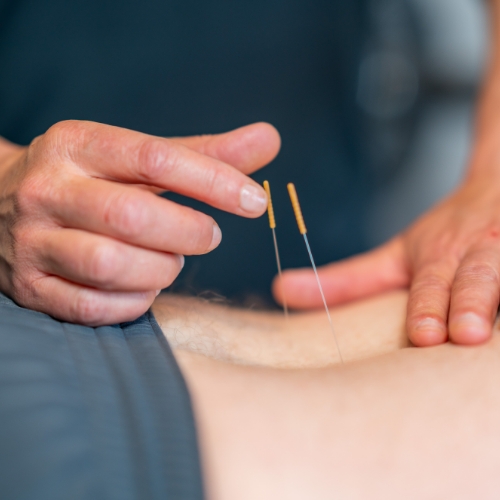 dry-needling-physioworks-physical-therapy-silverdale-kent-WA-500x500